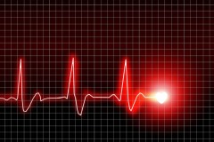 ECG Electrocardiogram